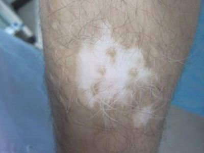 腿部白癜风有哪些症状？